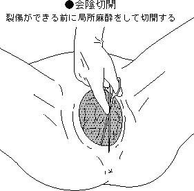出産でアソコを切開する場合も 男子が知らない 会陰切開 とは おにぎりまとめ