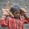 手が頭より大きくなる！手が巨大化する奇病と戦う８歳の男の子がインドにいる